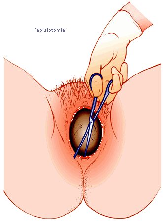 pisiotomie